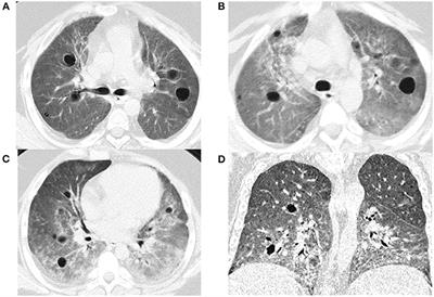 A Novel Mutation c.841C>T in COPA Syndrome of an 11-Year-Old Boy: A Case Report and Short Literature Review